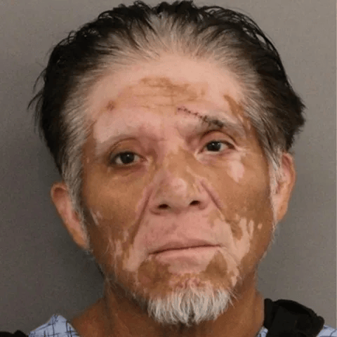 A middle-aged man with short dark hair and visible vitiligo patches on his face looks at the camera with a neutral expression.